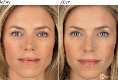 Injectable Facial Fillers Before and After Images