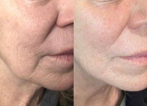 Cool Peel Laser Before and After Images