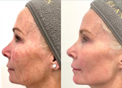Cool Peel Laser Before and After Images