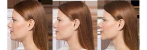kybella before and after pictures_compressed