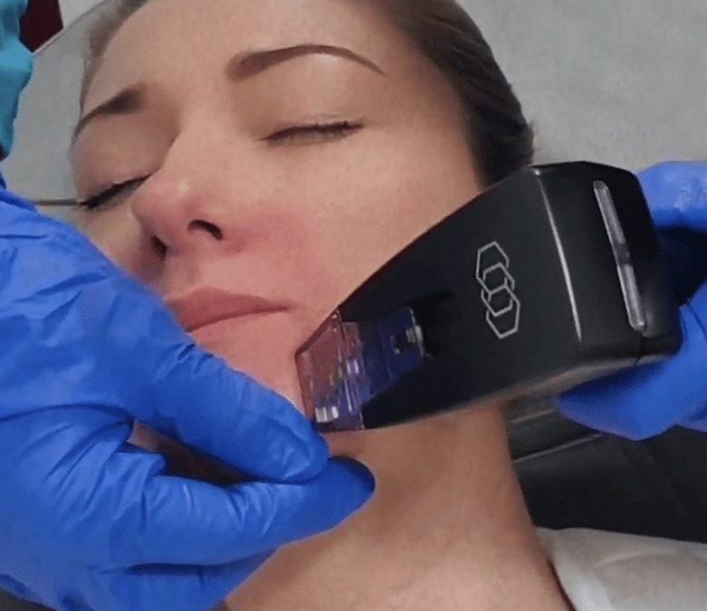 Image of a woman undergoing treatment with Morpheus8 system